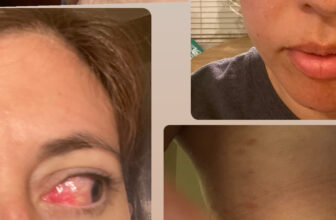 how I overcame autoimmune struggles