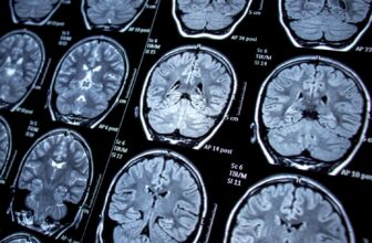 Can a Drug Stop Alzheimer’s Illness Many yea...